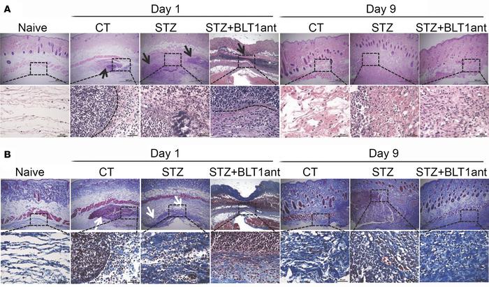 Diabetic mice have compromised abscess morphology.
(A) CT and STZ-treate...