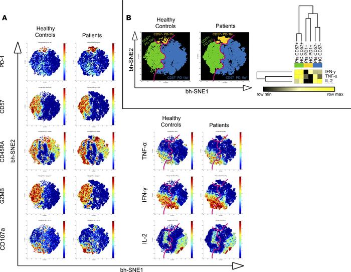Senescence and exhaustion phenotypes coexist in AML CD8+ T cells.
(A and...