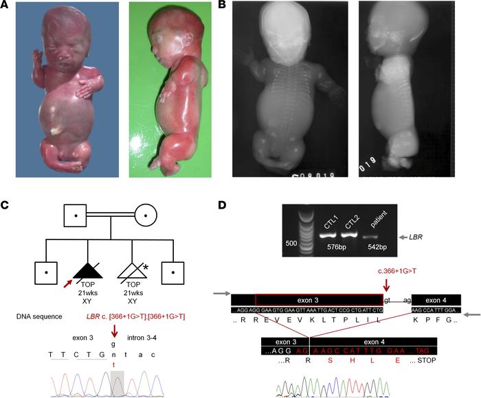 
LBR mutations cause a phenocopy of achondrogenesis 1A (ACG1A).
(A) Clin...
