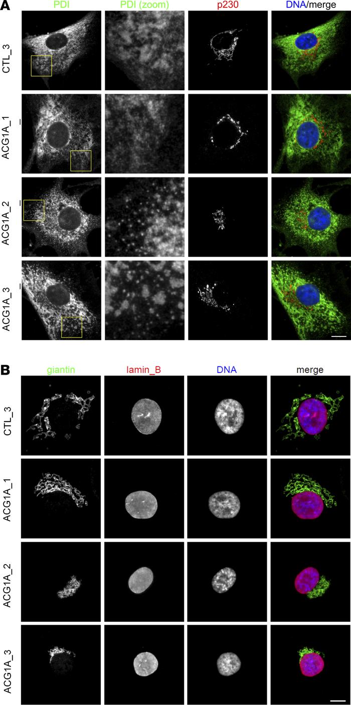 Endoplasmic reticulum (ER) and Golgi morphology in achondrogenesis 1A (A...