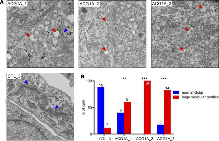 Abnormal vesiculation at the Golgi apparatus is a common cellular phenot...