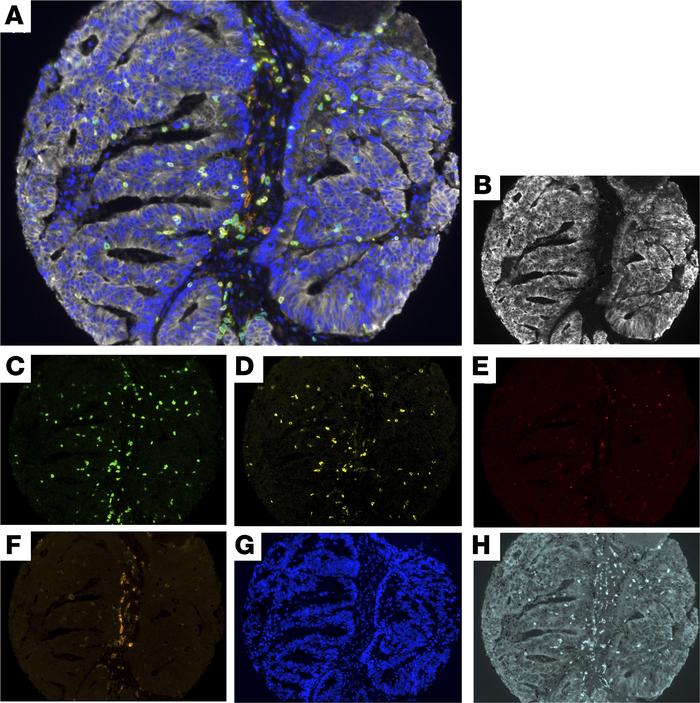 Multiplex fluorescent immunohistochemistry allows phenotyping of 7 uniqu...