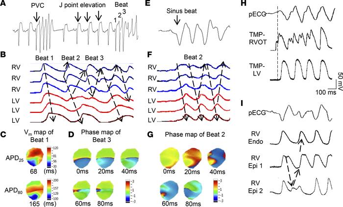 CyPPA induces spontaneous ventricular fibrillation (SVF) by phase 2 reen...