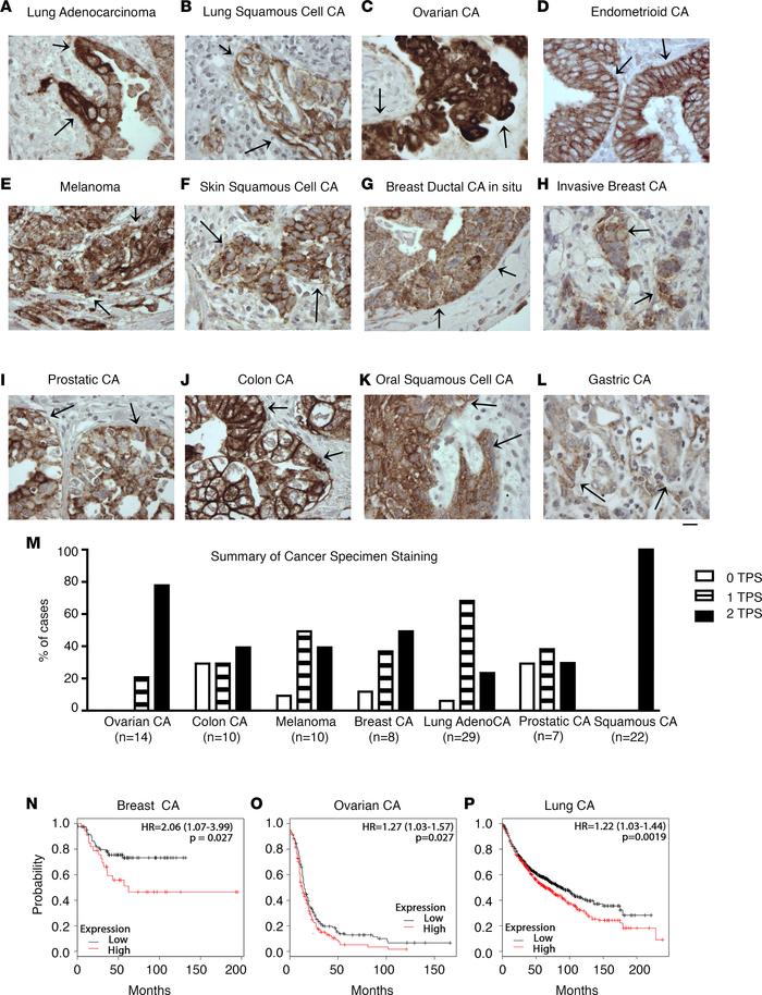 β8 expression in human carcinoma and melanoma specimens.
A highly specif...