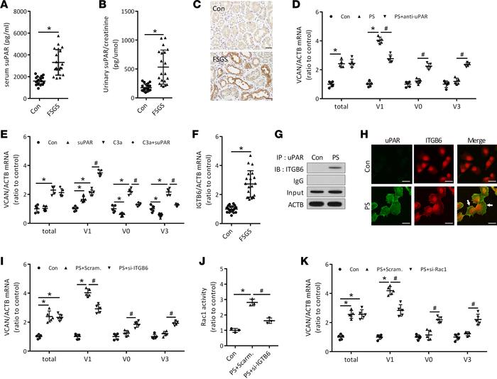 Effect of suPAR on the alternative splicing of versican pre-mRNA in tubu...