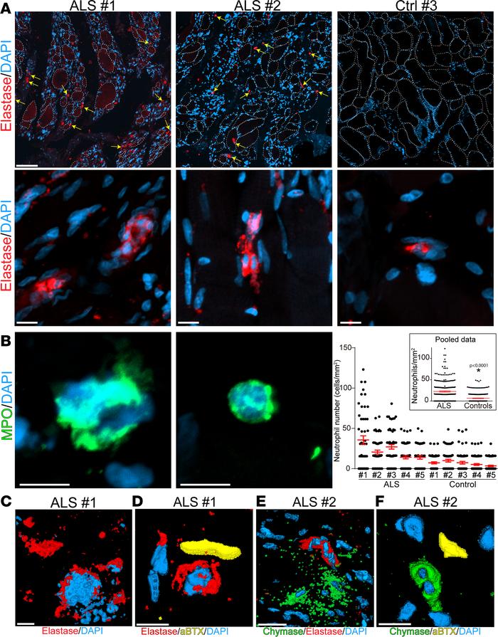Neutrophils infiltrate into the degenerating skeletal muscle of ALS pati...