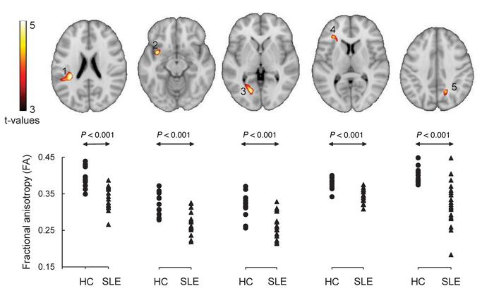 Regions with abnormal microstructure in SLE subjects.
Significant reduct...