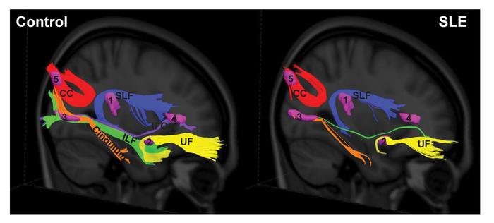 White matter pathways associated with the abnormal SLE-related regions v...