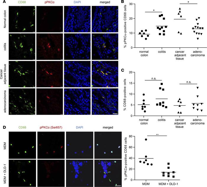 mTORC2 is downregulated in infiltrating macrophages in human CRC.
(A) IF...