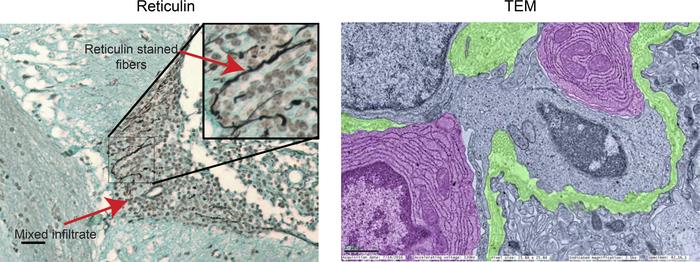 Stromal reorganization occurs within the CP cellular infiltrate.
Reticul...