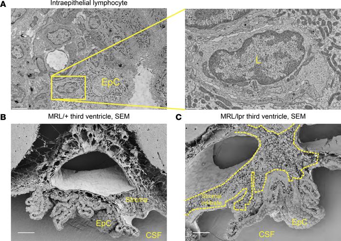 Ultrastructural evaluation reveals stromal expansion and T cell dissemin...