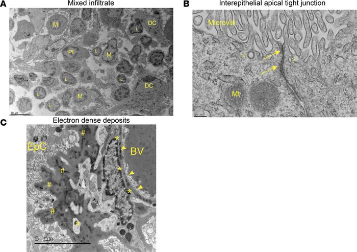 Ultrastructural evaluation reveals extensive leukocyte aggregation and i...