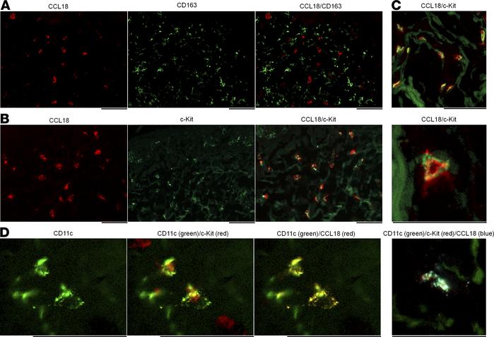 CCL18 is produced by c-Kit+ dendritic cells in mycosis fungoides (MF).
(...