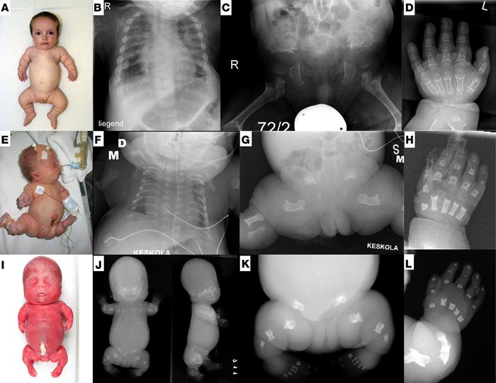 Clinical and radiographic spectrum of TRIP11-related disorders.
(A–D) Od...