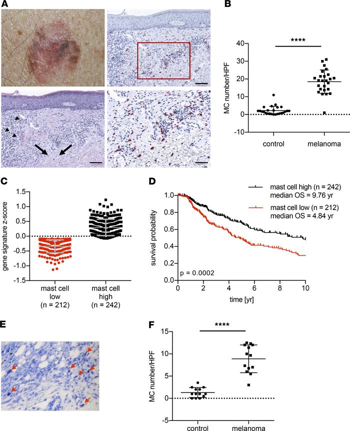Mast cell accumulation adjacent to melanomas.
(A) Representative photomi...