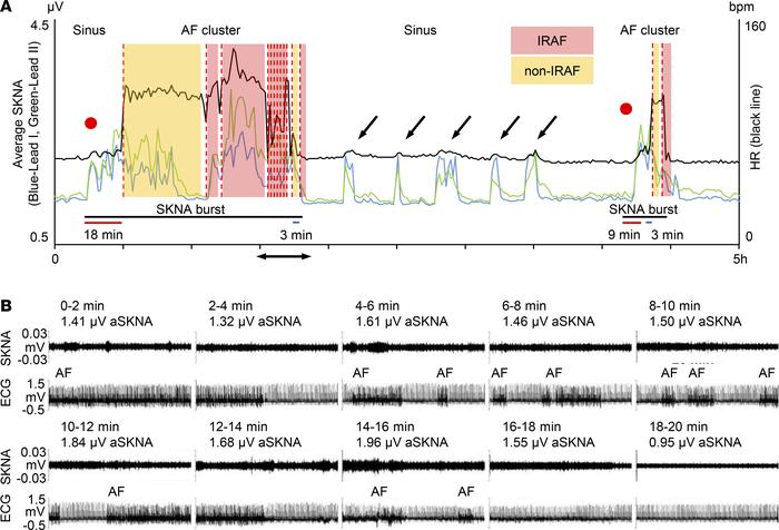 Typical examples of AF clustering.
The data came from the same patient a...