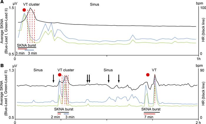 Clustering of VT episodes.
(A) The data came from same patient as shown ...
