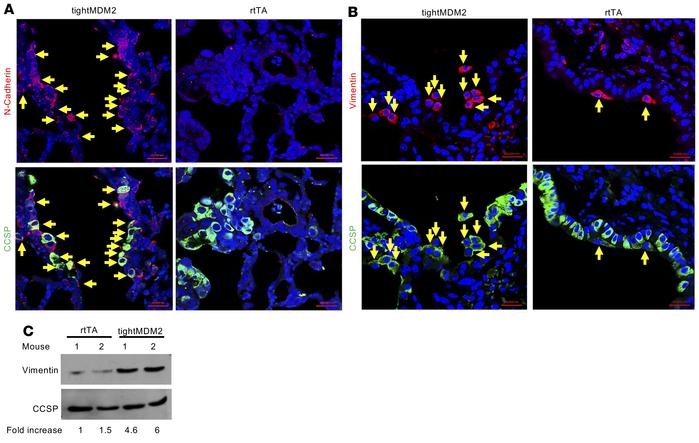 MDM2 enhances expression of EMT markers, N-cadherin, and vimentin, conse...