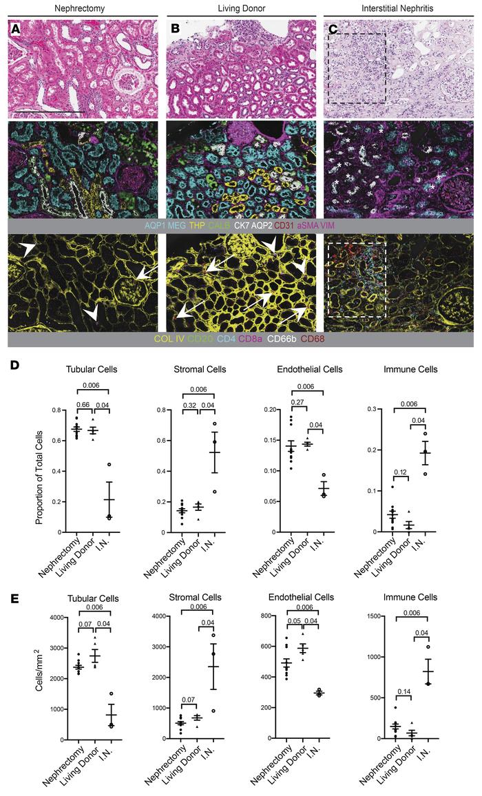 Comparative analysis of nephrectomy tissue, living donor tissue, and int...