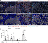 CD103 and CD69 expression by CD8+ TILs varies by localization within the tu