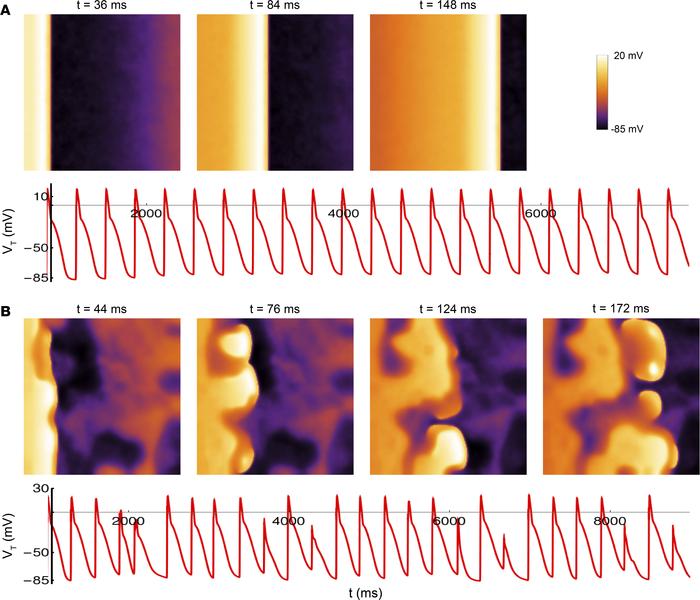 Spatially heterogeneous parasympathetic activity in the setting of high ...