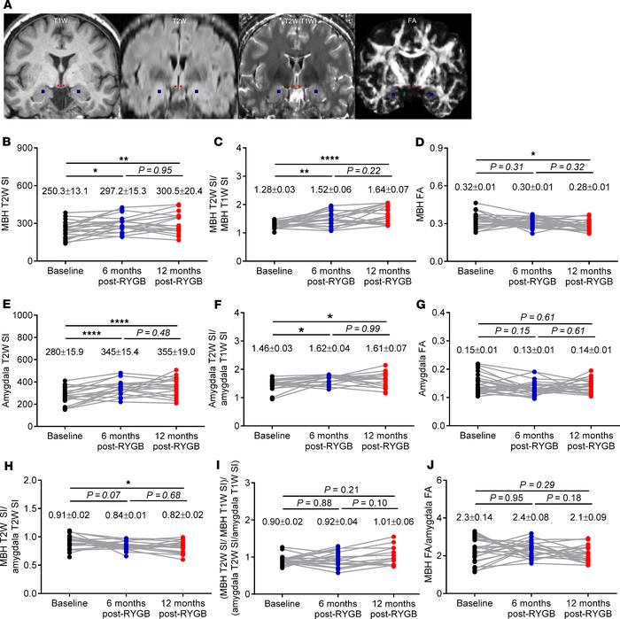 RYGB progressively alters radiologic measures of hypothalamic inflammati...