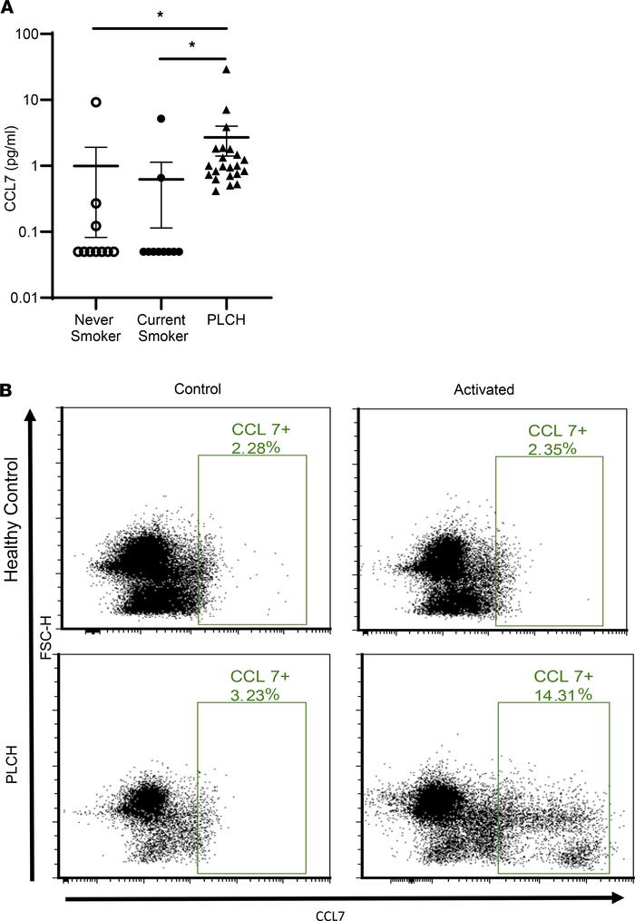 Increased CCL7 in the serum and CD11c+ PBMCs of PLCH patients.
(A) CCL7 ...