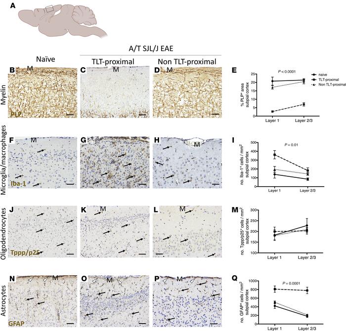 Meningeal inflammation is topographically related to a gradient of demye...