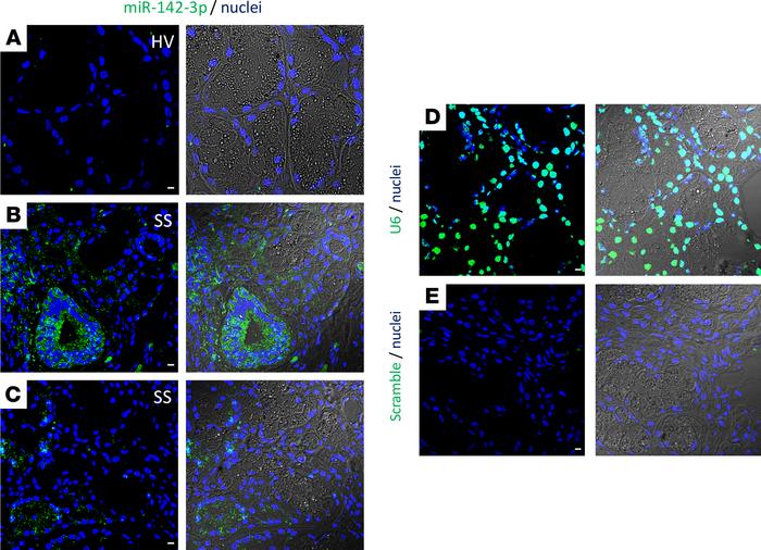 miR-142-3p expression in minor salivary gland tissues.
(A–C) ISH of miR-...