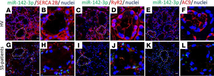 Expression of SERCA2B, RyR2, and AC9 is reduced in SGs of patients with ...