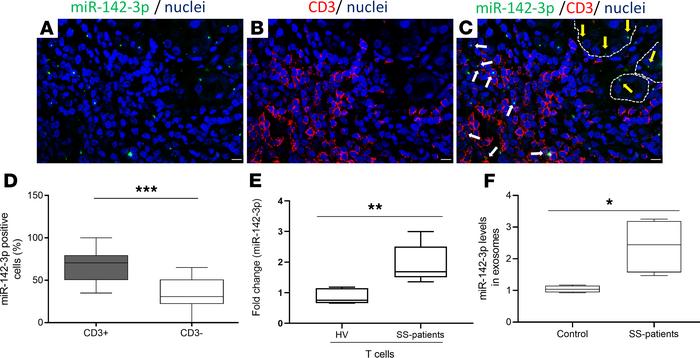 miR-142-3p is upregulated in salivary gland lesions and within secreted ...