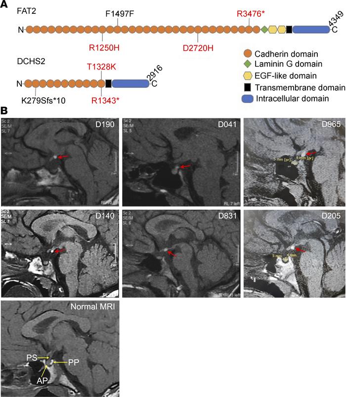 Variants in FAT2 and DCHS2 in patients with PSIS.
(A) Representative sch...