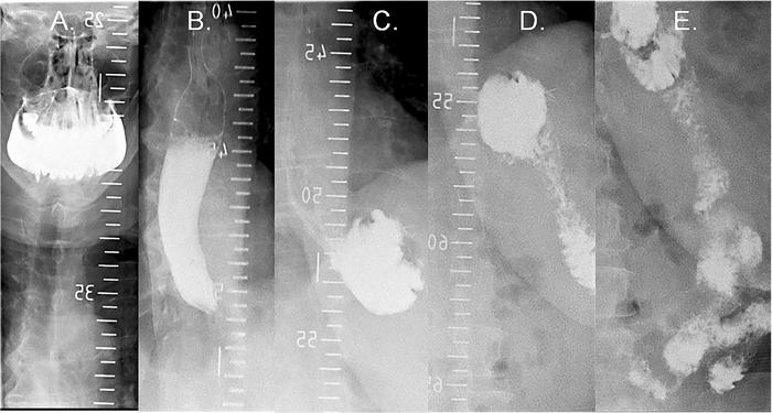 Oral contrast material swallow series in a patient after Roux-en-Y gastr...