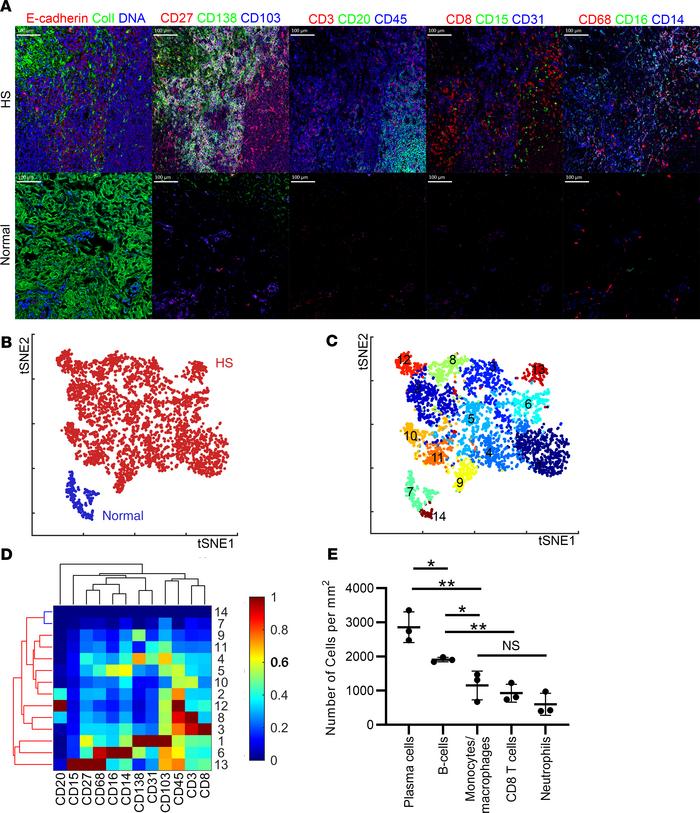B and plasma cells are the dominant infiltrating leukocytes in HS.
Analy...