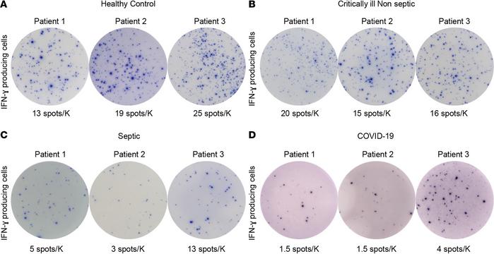 Adaptive immune suppression in COVID-19 patients.
Representative ELISpot...