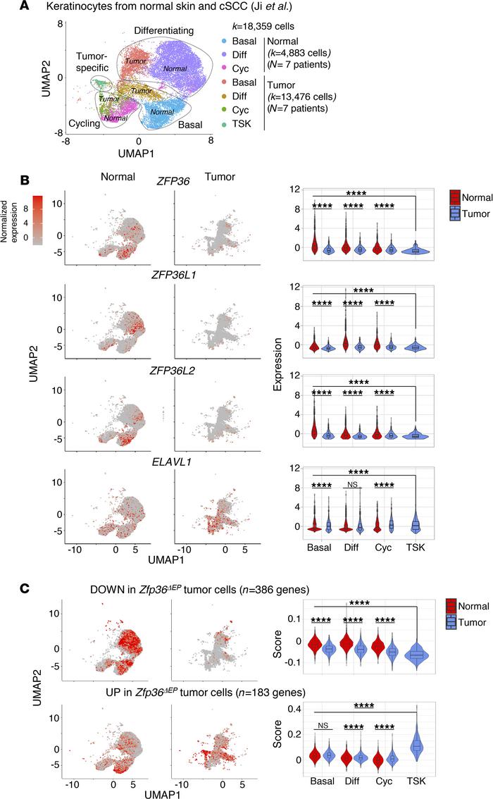 Downregulation of ZFP36 expression in human tumor-specific keratinocytes...