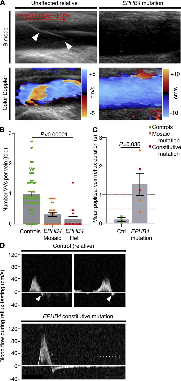 EPHB4 mutations cause human VV failure.
(A) VVs (arrowheads) were readil...