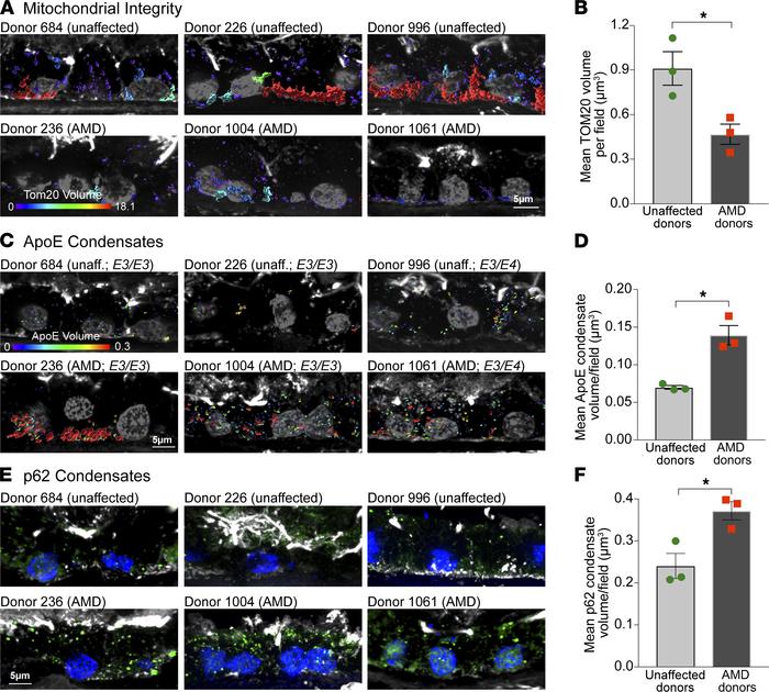 RPE mitochondrial injury correlates with ApoE and p62 condensates in AMD...