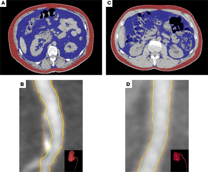 Visceral adiposity and noncalcified coronary artery burden in psoriasis....