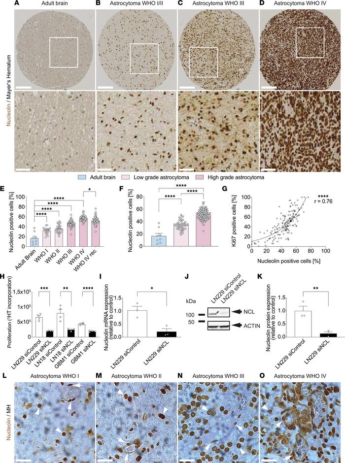 Expression of NCL increases during astrocytic tumor progression and NCL ...