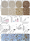 Expression of NCL increases during astrocytic tumor progression and NCL is