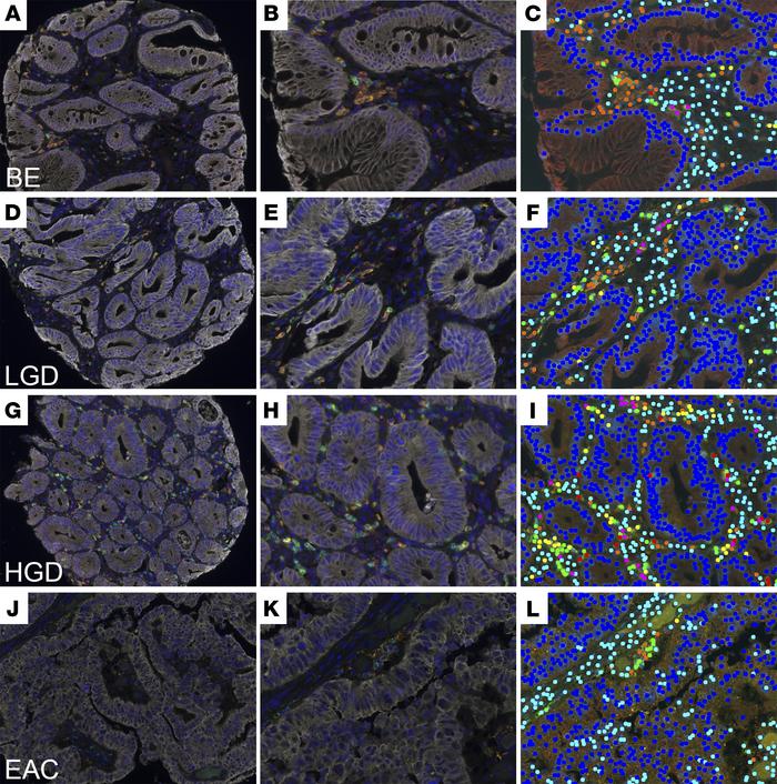 Multiplex immunohistochemical analysis of tissue sections from NDBE, LGD...
