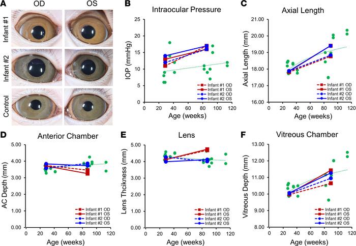 Anterior segment and ocular parameters of ZIKV-infected infant macaques....