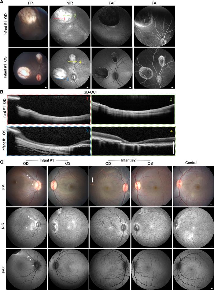 Multimodal imaging of chorioretinal lesions in ZIKV-infected infant maca...
