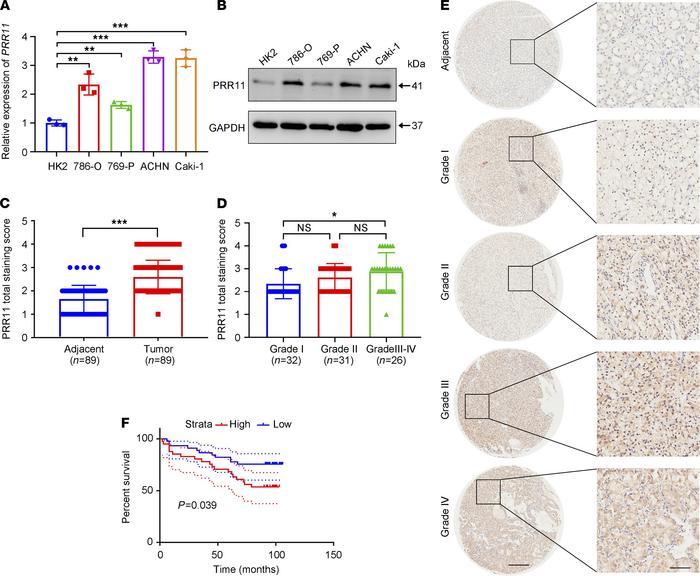 PRR11 is an independent factor of ccRCC.
(A and B) The expression level ...