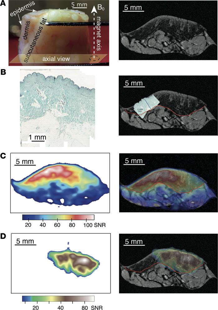 Illustration of 23Na MRI biopsy.
(A) Photograph of a typical skin sample...