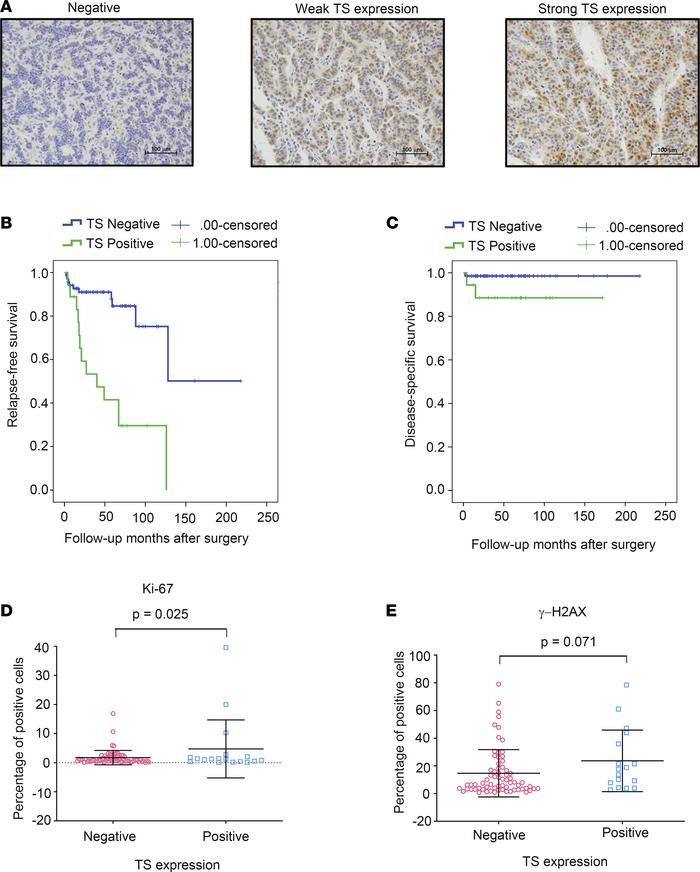 TS expression level in human PanNETs is correlated with patient outcome ...