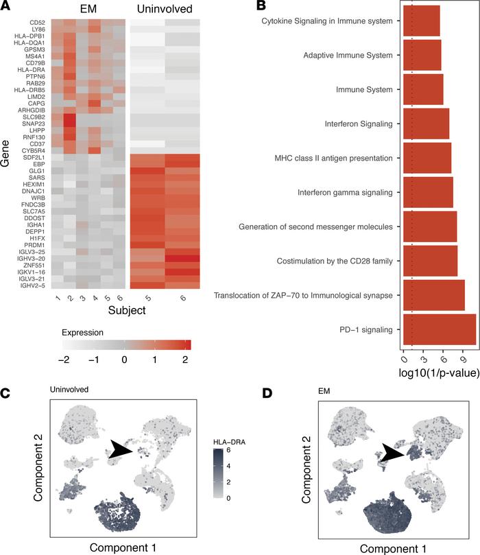 B cells in EM lesions express high levels of MHC class II genes and sign...
