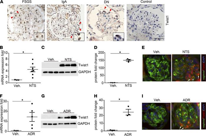 Induction of Twist1 in podocytes from patients with podocytopathies and ...