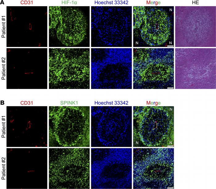 SPINK1 protein is expressed in severely hypoxic regions and secreted to ...